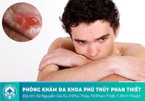 Dương vật bị lở loét ai ngờ là dấu hiệu ung thư!