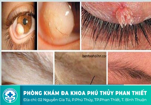 Sùi mào gà ở mắt do đâu?