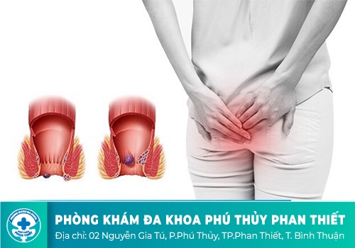 Bệnh trĩ nội là gì?