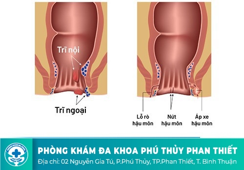 Thuốc bôi chữa các bệnh hậu môn có thực sự hiệu quả?