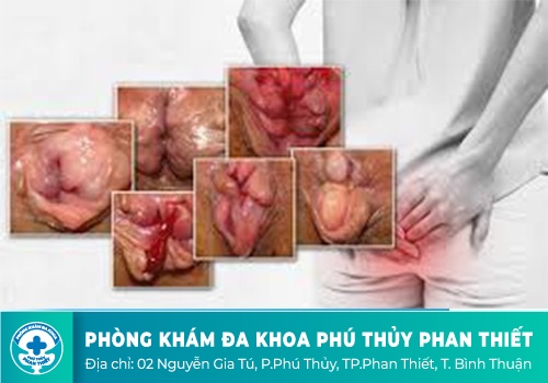 Hậu môn bị lòi thịt dư là dấu hiệu bệnh gì?