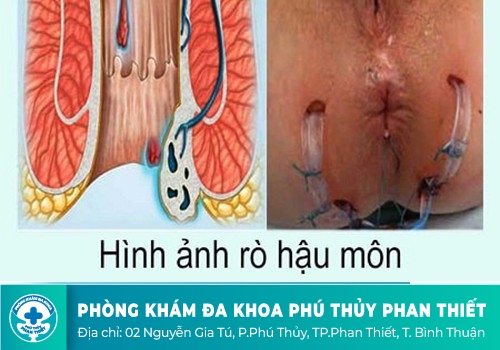 Nguyên nhân gây nứt kẽ hậu môn
