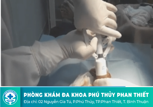 Ưu điểm khi cắt bao quy đầu bằng công nghệ Surkon Hàn Quốc