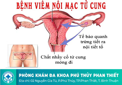 Viêm nội mạc tử cung ở nữ giới là bị gì?
