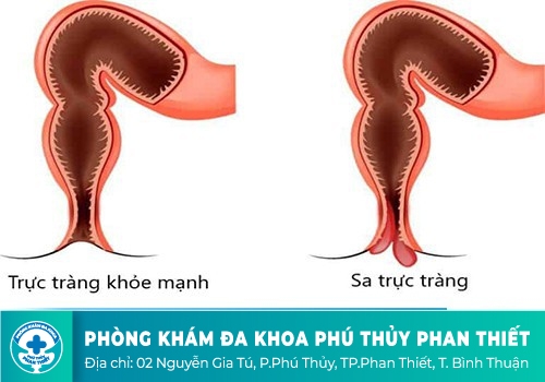 Sa niêm mạc trực tràng