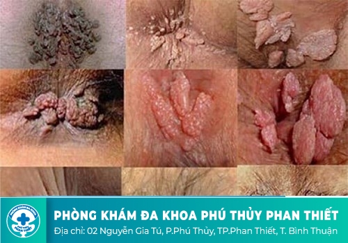 Địa chỉ khám bệnh hậu môn uy tín ở Bình Thuận