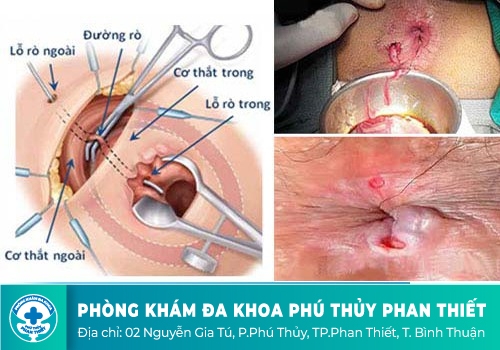 Địa chỉ khám bệnh hậu môn uy tín ở Bình Thuận