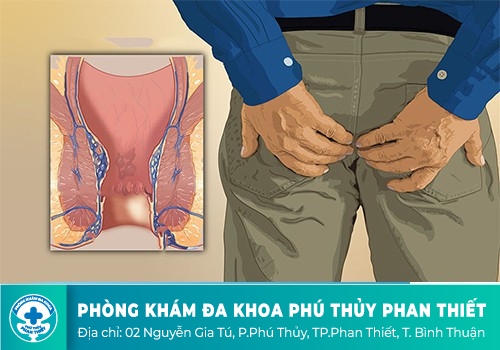 Bệnh trĩ có gây ngứa không?