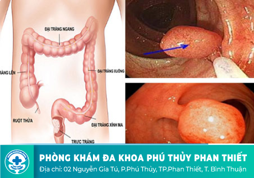 Polyp trực tràng là gì?