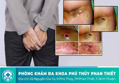 Rách hậu môn là gì?