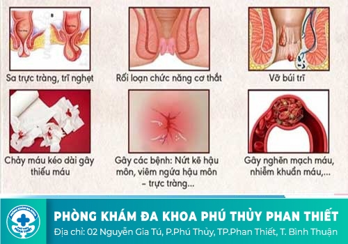 Polyp trực tràng có những biểu hiện gì?