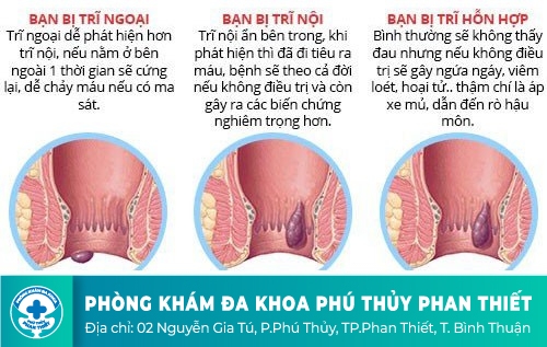 Nhận biết các dạng bệnh trĩ