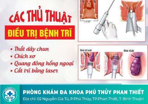 Cách chữa bệnh trĩ an toàn và hiệu quả hiện nay
