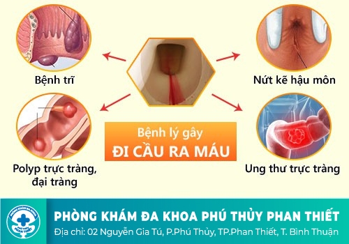 Đi cầu ra máu là bệnh gì?