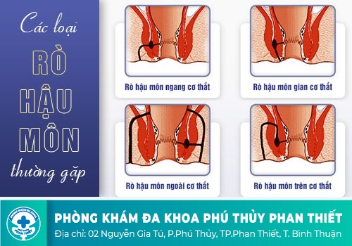 Hình ảnh rò hậu môn