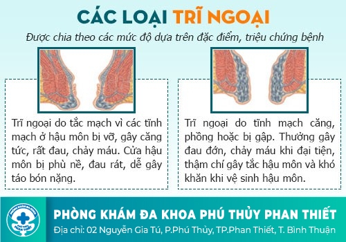 Cách điều trị bệnh trĩ hiệu quả, nhanh khỏi