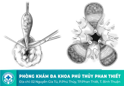 Điều trị bệnh trĩ bằng kỹ thuật thắt búi trĩ truyền thống