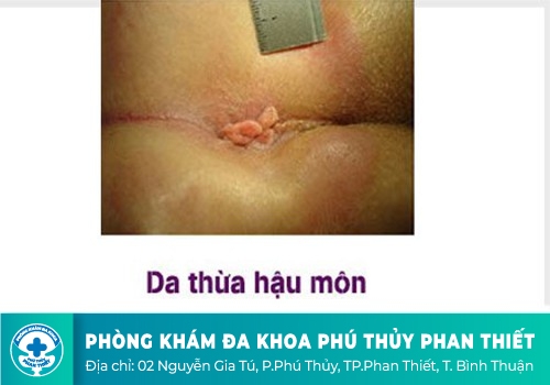 Thịt dư ở hậu môn không đau vì khối da thừa