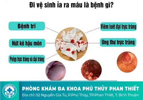 Đi ngoài ra máu và chất nhầy là dấu hiệu bị gì?
