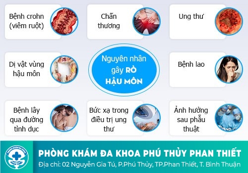  Nguyên nhân nào dẫn đến rò hậu môn?