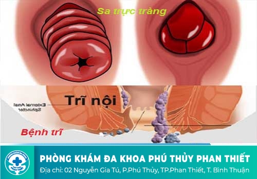 Sa trực tràng