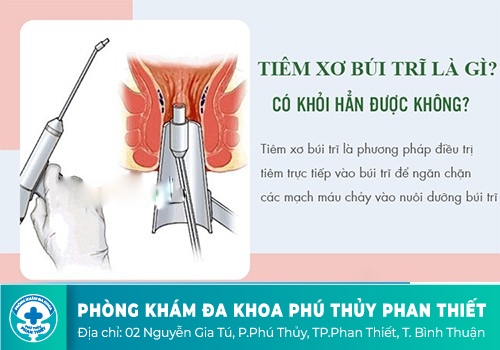  Điều trị bệnh trĩ bằng phương án chích xơ búi trĩ