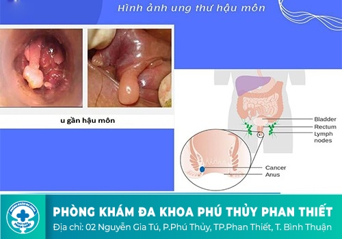 Hậu môn nổi cục cứng đau là dấu hiệu của bệnh gì