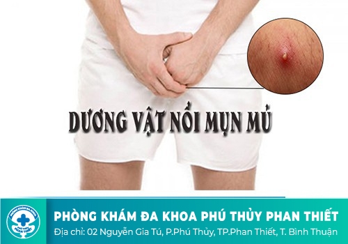 Nổi mụn ở bìu tinh hoàn là dấu hiệu bệnh gì?