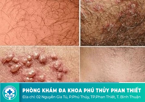 Điểm danh những căn bệnh dễ lây cho cậu nhỏ