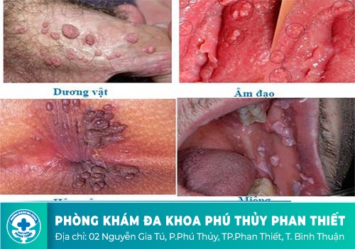 U nhú sinh dục là gì?