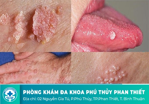 BỆNH SÙI MÀO GÀ Ở MIỆNG