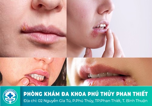 Hình ảnh bệnh mụn rộp sinh dục ở miệng, môi, mắt