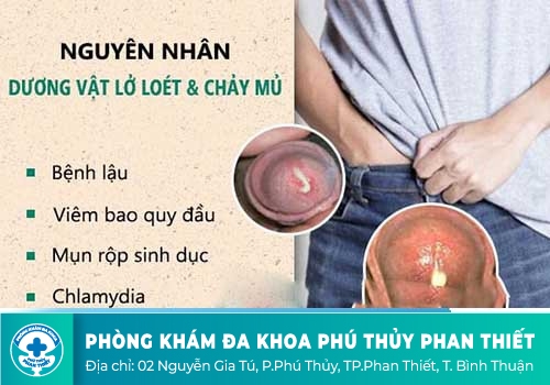 LOÉT DƯƠNG VẬT LÀ TRIỆU CHỨNG CỦA BỆNH GÌ?
