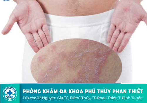 Nổi mụn ở bìu là dấu hiệu của bệnh lý gì?