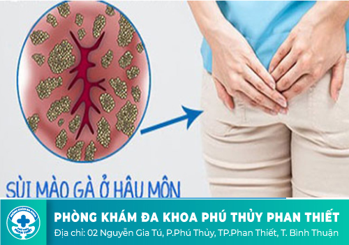 Bệnh sùi mào gà ở hậu môn và những điều cần biết