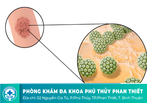 Nổi mụn thịt hậu môn khả năng mắc sùi mào gà