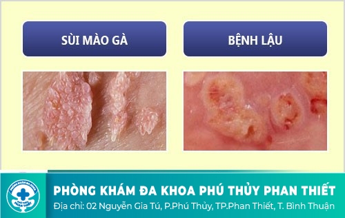 Kiểm tra xem bạn có những dấu hiệu mắc bệnh ở dương vật hay không