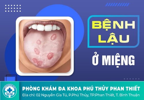  triệu chứng bệnh lậu 