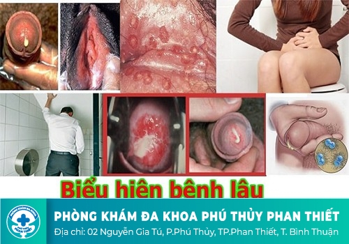 So sánh sự khác biệt giữa 4 loại bệnh tình dục phổ biến hiện nay