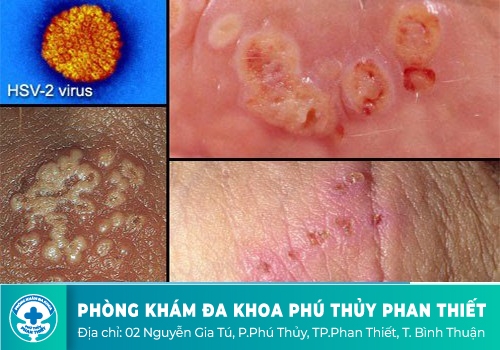 Nguyên nhân mắc bệnh lây truyền qua đường tình dục là gì?