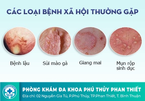 Các bệnh ở bộ phận sinh dục nam phổ biến hiện nay