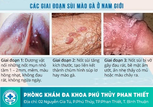 Bệnh sùi mào gà là gì?
