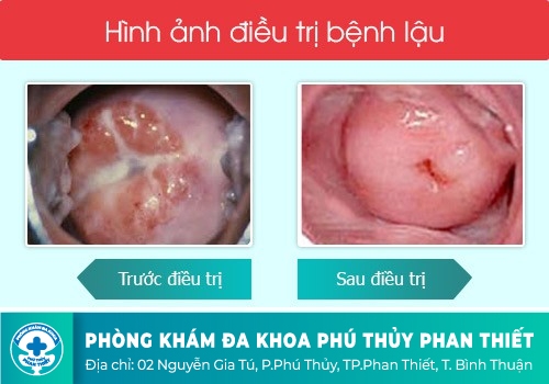 Điều trị bệnh lậu bao lâu thì khỏi