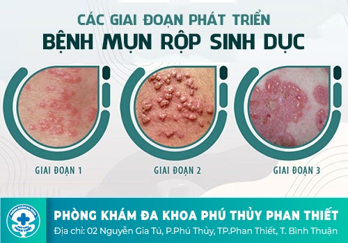 NGUYÊN NHÂN GÂY RA BỆNH MỤN RỤP SINH DỤC?