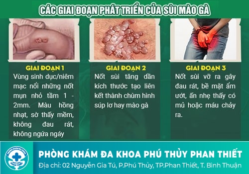 Triệu chứng và các giai đoạn phát triển của sùi mào gà