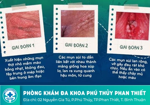 Biểu hiện sùi mào gà âm đạo không thể bỏ qua