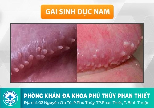 Gai sinh dục là gì?