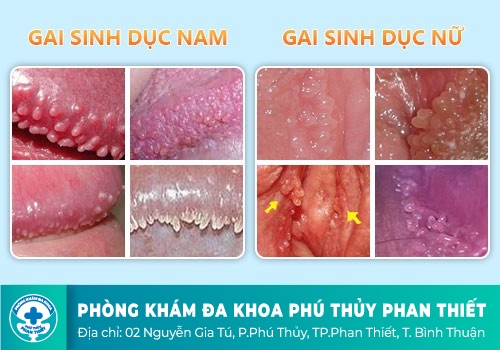 MỌC GAI Ở CƠ QUAN SINH DỤC LÀ BIỂU HIỆN CỦA BỆNH GÌ?