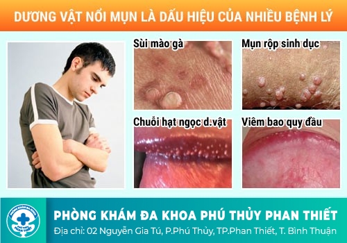 Giải đáp dương vật bị ngứa và chảy mủ là bệnh gì
