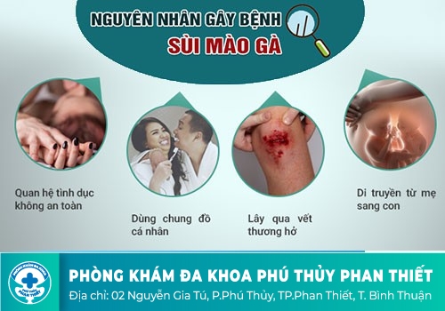 Nguyên nhân lây nhiễm sùi mào gà là gì?